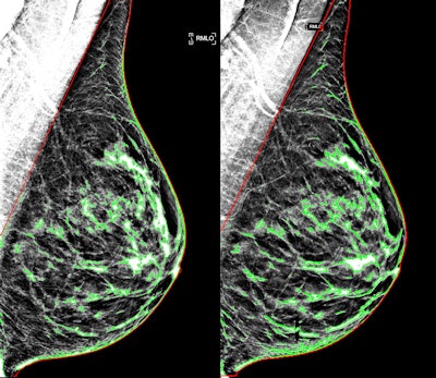 Examples of a screening digital mammogram (left) and synthetic mammogram (right) with 10% and 11% percent density, respectively, demonstrating substantial agreement in quantitative density estimation. Images courtesy of Despina Kontos, PhD.