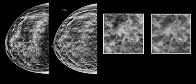 A synthesized 2D DBT image. Image courtesy of Hologic.