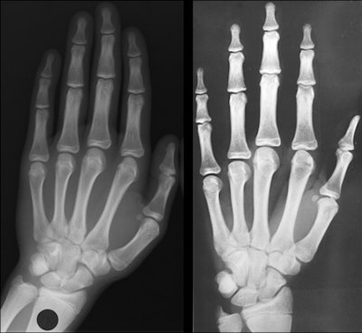 Left: Clinical x-ray of a young male with a chronological age of 16 years and 4 months. Right The closest image in the Greulich and Pyle Atlas is the male standard number 28 corresponding to a skeletal age of 16 years old. A limitation of bone maturation assessment using GP atlas images is that similarity can only help determine skeletal age, not chronological age. Images courtesy of Dr. Fabrice Dedouit, PhD.
