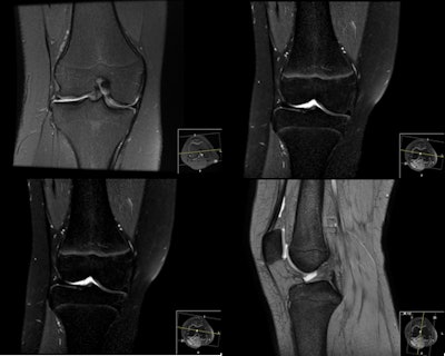 Measurements taken from knee MRI can help determine age, but protocols and grade scales must be standardized for routine practice in bone maturation assessment. Images courtesy of Dr. Sandra Diaz Ruiz, PhD.