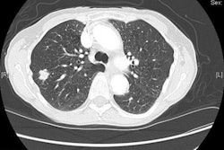 2017 03 01 15 23 43 165 Sa5 Lung Cancer Screening Image 20170301222409