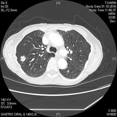 Solid lobulated nodule in the right upper lobe represents non-small cell lung cancer in a 73-year-old female smoker. Image courtesy of Dr. Stefan Diederich, PhD.