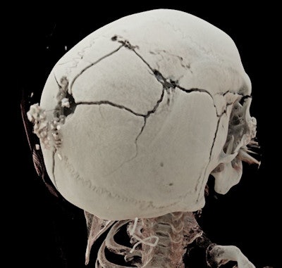 3D-rendered image shows the exit wound of a ballistic projectile in a neutral bloodless manner favored by juries and investigators. Image courtesy of Dr. Thomas Ruder.