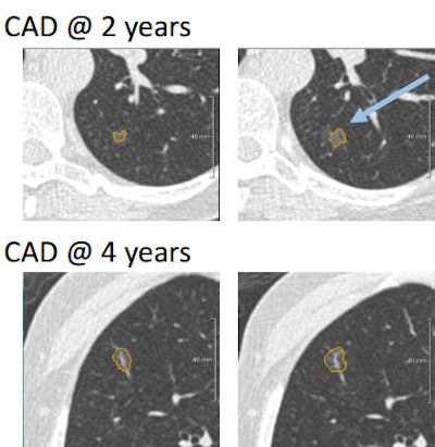 Nearly half of subsolid nodules initially missed by CAD (top row) were detected in subsequent screening rounds (bottom row). No subsolid nodules missed by CAD became cancer.