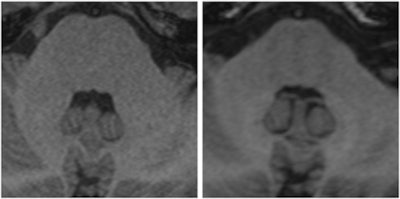Two images of a patient prior to (left) and after (right) nine injections of the linear gadolinium-based contrast agent Magnevist. The image prior to injection shows no hyperintensities displayed in the dentate nucleus, while a clear signal intensity increase in the dentate nucleus becomes visible after nine injections of Magnevist. Images courtesy of Dr. Alexander Radbruch, head of neuro-oncologic imaging at the University Hospital Heidelberg in Germany.
