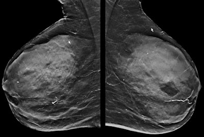 The dense mammogram (top) is negative, but an abbreviated breast MRI study (below) in the same patient is positive for small invasive cancer. In the first postcontrast subtracted image (Fast; bottom) of the slice and the corresponding maximum intensity projection image, the cancer can be clearly seen in the same patient. The patient underwent a MRI-guided biopsy, which confirmed presence of a grade 2 invasive cancer (no special type), 8 mm in longest diameter. All images courtesy of Dr. Christiane Kuhl.