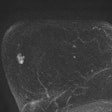 2017 03 04 12 40 22 555 2017 03 05 Breast Mri Thumb2