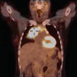 2017 03 06 11 31 38 851 Coronal Pet Ct Mol Insider Image 200