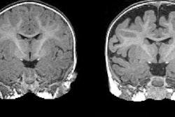 2017 03 07 16 00 13 378 Mri Autism Csf Levels 20170307230107