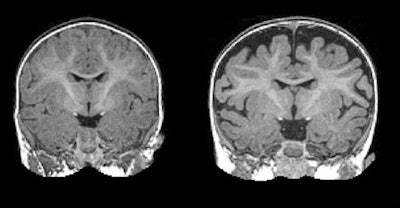 MRI of a 6-month-old baby (right) diagnosed with autism at 2 years of age. The dark space between the brain folds and skull indicates increased amounts of CSF. By comparison, a 2-year-old (left) who was not diagnosed with autism at age 2 shows less CSF. Images courtesy of the Carolina Institute for Developmental Disabilities and Biological Psychiatry.