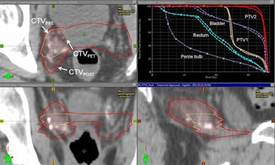 Representative example of target definition with fluciclovine-PET. Images courtesy of Dr. Ashesh Jani, Dr. David Schuster, and JNM.