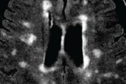 2017 03 08 15 54 26 640 Multiple Sclerosis 20170308225515