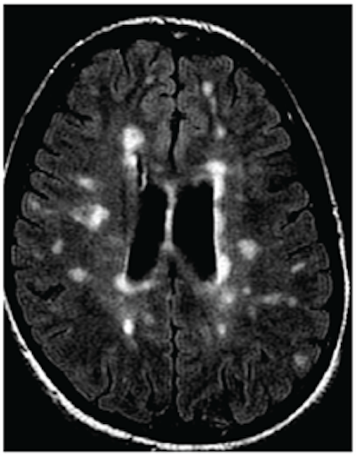 MRI of a person with multiple sclerosis. White areas show permanent scarring caused by the disease. Image courtesy of the University of British Columbia.