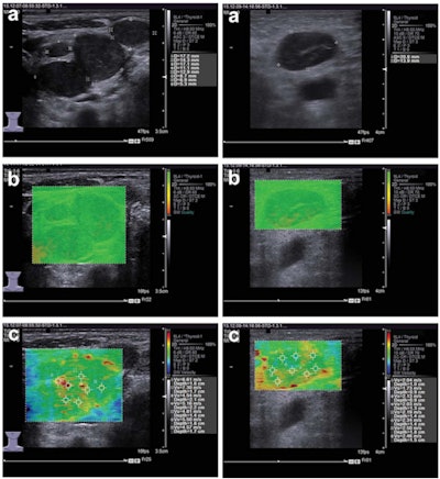 Left: Images of metastatic cervical lymph node. (A) Irregular low-echo nodules can be seen on conventional ultrasound, but the structure of the lymph node hilum is unclear. (B) Using 'quality mode' on the VTIQ software, the lesion appears green with some yellow, showing good elasticity. (C) Using 'velocity mode' on the VTIQ software, the shear-wave velocity values are shown for different points in the lesion. Right: Images of nonmetastatic lymph node. (A) An oval hypoechoic nodule can be seen on the conventional ultrasound, but the structure of the lymph node hilum is also unclear. (B) and (C), same descriptions as for previous image. All images courtesy of the Journal of Ultrasound in Medicine.