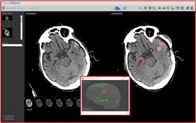 The MedyMatch application analyzes noncontrast head CT scans for signs of brain bleeds. Image courtesy of MedyMatch Technology.