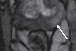 2017 03 16 16 21 02 669 Mri Prostate Ajr 02 400