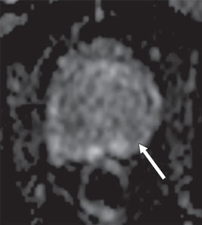 Initial multiparametric MRI (above) before active surveillance shows poorly defined mild hypointense signal at right posterolateral midperipheral zone (arrow). Follow-up multiparametric MRI two years later (below) better details area of hypointense signal (arrow). Images courtesy of AJR.