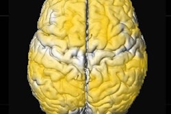 2017 03 20 09 46 25 911 Mri Kids Sleep Apnea Image 01 20170320164708