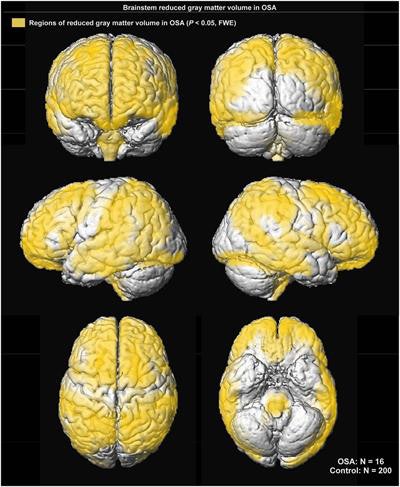 Images show regions of reduced gray-matter volume (yellow) in subjects with obstructive sleep apnea versus control subjects. Courtesy of Dr. Mona Philby et al.