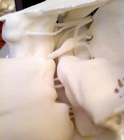 Additional views of 3D-printed cranial nerve model created from MRI and CT of the cerebellopontine angle and skull base.