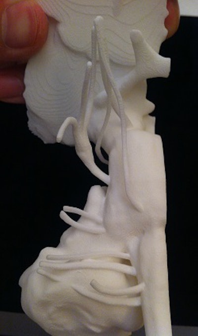 Image of 3D-printed cranial nerve model created from MR and CT images of the cerebellopontine angle and skull base. All images courtesy of Dr. Ramin Javan.
