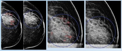 False positive for radiologist and true negative for qCAD. Fine linear branching and rim calcifications measuring 7 cm with regional distribution in the middle lateral region: path-proven fat necrosis.