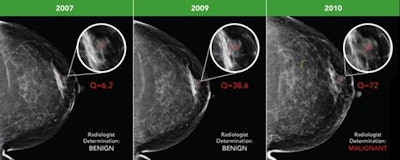 Early breast cancer was flagged by the CAD software three years prior to biopsy and showed a progressive increase in quantitative score over the three years. All images courtesy of Dr. Alyssa Watanabe.