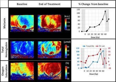 SFDI of melanin, total hemoglobin, and oxygen saturation of the treated breast of a 49-year-old patient at baseline and at the end of radiation treatment. Right panels show the percent change from baseline of melanin (top) and total hemoglobin and oxygen saturation (bottom). Image courtesy of Anaïs Leproux, PhD, and the Beckman Laser Institute and Medical Clinic.