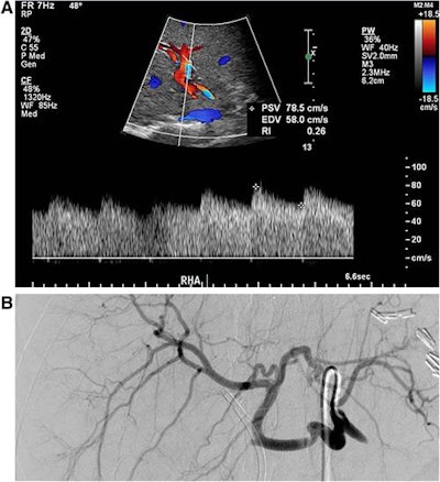 False-positive case from the resistive index method. Spectral Doppler ultrasound of the right hepatic artery shows a sloping upstroke (A); the resistive index method was low at 0.26, but the stenosis index was high at 1.74. Although there was concern about transplant hepatic arterial stenosis (based on the low resistive index), the digital subtraction celiac angiography (B) showed no flow-limiting stenosis in the hepatic vasculature. As a result, the resistive index method produced a false-positive result. Image courtesy of the Journal of Ultrasound in Medicine.
