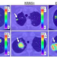 2017 04 04 10 00 30 308 Pet Nsclc Jnm Image 500