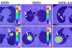 2017 04 04 10 00 30 308 Pet Nsclc Jnm Image 500