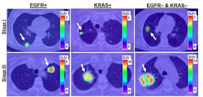 2017 04 04 10 00 30 308 Pet Nsclc Jnm Image 500