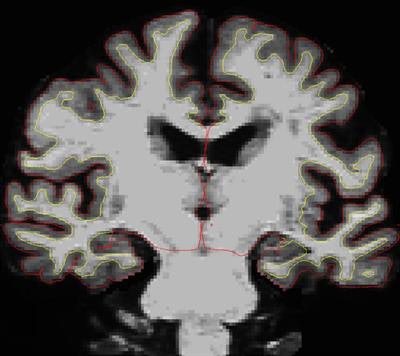 MR image of a SuperAger's brain. The portion between the yellow and red lines is the cortex. Image courtesy of Northwestern University.