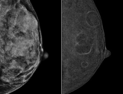 Left mediolateral oblique (MLO) digital mammography image (left) from a 49-year-old high-risk patient with extremely dense breasts. CEDM image (right) shows multiple benign rim-enhancing masses compatible with benign cysts. Images courtesy of Dr. Bhavika Patel.