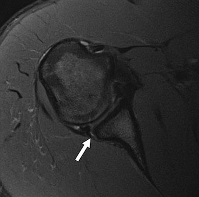 A posterior labral tear (arrow) in a 20-year-old man detected with axial T2-weighted multiplanar 2D fast spin-echo unenhanced standard MRI (above) and the fast five-minute protocol (below) using 3-tesla MRI. Images courtesy of AJR.