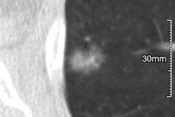 2017 04 19 16 44 07 776 2017 04 20 Chung Fig2 Lung Rads 20170419234509