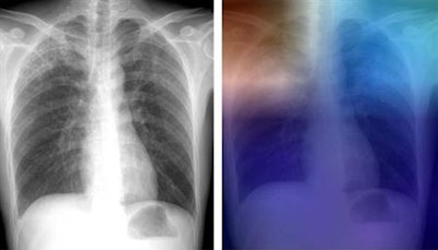 Left: Posteroanterior chest radiograph shows upper lobe opacities with pathologic analysis-proven active TB. Right: Same chest radiograph, with a heat map overlay of one of the strongest activations obtained from the fifth convolutional layer after it was passed through the GoogLeNet-TA classifier. The red and light blue regions in the upper lobes represent areas activated by the deep neural network. The dark purple background represents areas that are not activated. This shows that the network is focusing on parts of the image where the disease is present (both upper lobes). Image courtesy of RSNA.