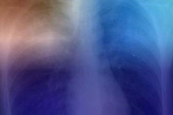 2017 04 25 15 52 00 596 2017 04 26 Ai Tuberculosis 20170425225716