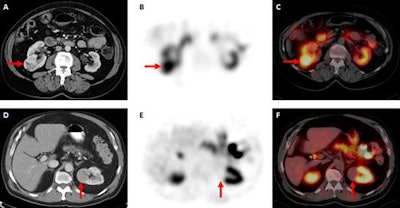 Axial contrast-enhanced CT image (A) demonstrates an enhancing mass in the lateral right kidney (red arrow). Tc-99m-sestamibi axial SPECT (B) and axial SPECT/CT images (C) show intense radiotracer uptake in the right kidney mass (red arrows), which is typical in oncocytomas and other benign/indolent neoplasms such as hybrid oncocytic/chromophobe tumors. Axial contrast-enhanced CT (D) shows an enhancing mass in the medial aspect of the left kidney (red arrow). Tc-99m-sestamibi axial SPECT (E) and axial SPECT/CT (F) images show complete photopenia in the mass (red arrows), which is typical with clear cell renal cell carcinomas. Images courtesy of Drs. Steven Rowe, Mohamad Allaf, and Michael Goren.
