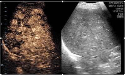 Contrast wash-in demonstrates the ability of contrast agents to enhance the visualization of tumors. Amber image (left) is the contrast image (cubic fundamental with synthetic spatial compounding); image on right is simple fundamental B-mode image. Images are of the liver, using a C4-1 transducer. All images courtesy of Glen McLaughlin, PhD.