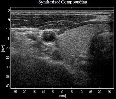 Synthesized spatially compounded image (above) of the thyroid versus original image (below) shows a reduction in speckle spatial variance and higher contrast resolution.