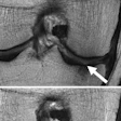 2017 05 01 16 22 49 399 Knee Degeneration Gersing Rad 20170501232328