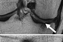 2017 05 01 16 22 49 399 Knee Degeneration Gersing Rad 20170501232328