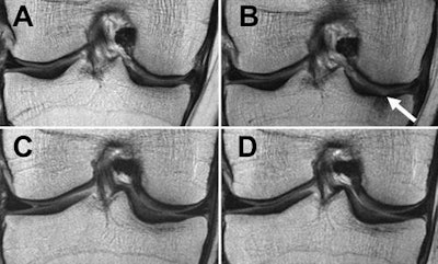 MRI scans of right knee at baseline (A and C) and after 48 months (B and D). Top-row images are of an obese 65-year-old woman with stable weight and mild knee pain; bottom-row images are of an obese 64-year-old woman with weight loss (11% less BMI) over 48 months. The woman with stable weight developed a full-thickness focal cartilage defect at the medial tibia (arrow). In contrast, no cartilage defects were seen in the woman with weight loss. Images courtesy of Radiology.