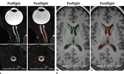 MR images show the orbit and brain with the automated delineation of orbital and ventricular CSF spaces obtained before flight (green) and after flight (red) for a long-duration male astronaut. Orthogonal planes of the orbital CSF demonstrate postflight expansion and elongation of the CSF space around and along the length of the optic nerve. Images courtesy of Radiology.