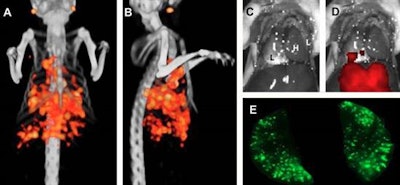 Example of dual-modality imaging in a mouse one week after tumor cell injection. Pulmonary tumor lesions in the liver and lymph nodes are visualized with micro-SPECT/CT (A, B). After resection of the thoracoabdominal wall, no tumor lesions were visible with the naked eye (C). Fluorescence imaging identified the superficially located tumor lesions (D), and fluorescence imaging of the resected lungs visualized numerous pulmonary lesions (E) (L = lung, H = heart). Images courtesy of Dr. Marlène Hekman and JNM.