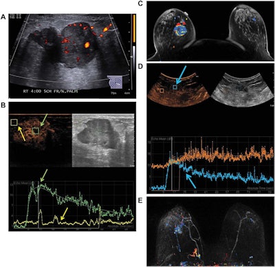 2017 05 15 14 41 08 732 Lee Ceus Breast Jum 400