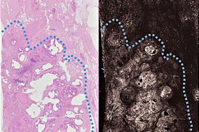 The new technique (right) produces images as detailed and accurate as the frozen section method (left), but in far less time. Cancerous breast tissue is below the dotted blue line. Credit: Terence T. W. Wong.