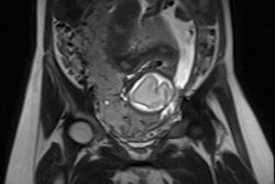 2017 05 19 11 03 54 785 2017 05 22 Placenta Thumb