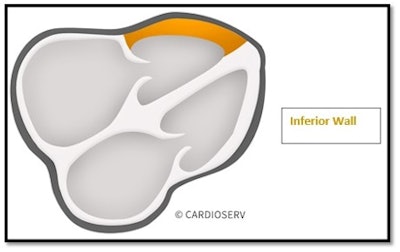 Subcostal four-chamber view